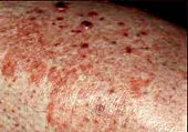 Learn More About Fungus Infections Learn More About Fungus Infections