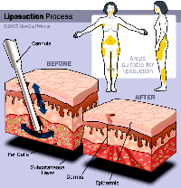 liposuction process