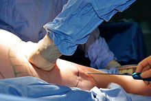 Get Affordable Liposuction Surgery Get Affordable Liposuction Surgery